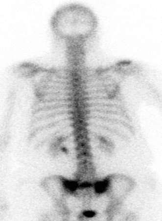 Illustration of sacral insufficiency fractures - Dr. Mohammed Hutaif