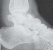 Illustration 2 for Talar Neck Fracture Treatment: Optimizing Recovery with ORIF