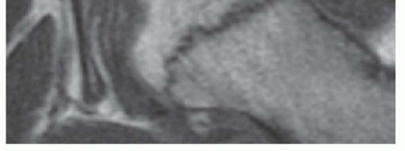 Illustration 4 for Labral Support Shelf Procedure: Preventing Perthes Deformity