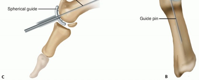 Illustration 17 for End Articular Cartilage Loss: Arthrosurface HemiCAP Resurfacing