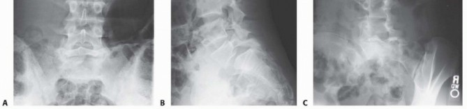 Illustration 6 for Mastering High-Grade Spondylolisthesis: Posterolateral and Interbody Fusion