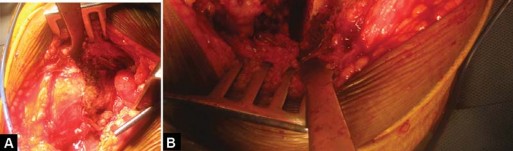 Illustration 33 for Total Hip Arthroplasty: Restoring Mobility in Juvenile Idiopathic Arthritis