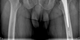 Illustration 9 for Advanced Bilateral Simultaneous THA: Uncemented Monobloc Case Title