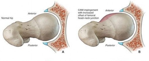 Illustration 11 for Precision Hip Arthroscopy: Unlock Access to the Peripheral Compartment