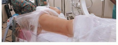 Illustration 6 for Anterior Interbody Arthrodesis for Scoliosis: What You Need to Know