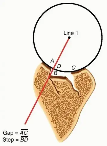 صورة توضيحية لـ جراحة تقويم عظم الكعبرة البعيد: الحل لاستعادة وظيفة اليد والمعصم