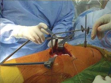 Illustration 63 for Successful Total Hip Replacement in Developmental Dysplasia