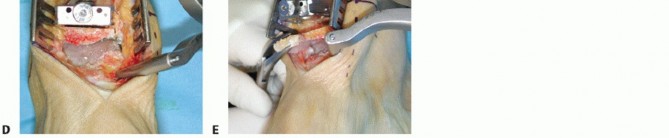 Illustration 14 for HINTEGRA Total Ankle: Unlocking Natural Ankle Movement