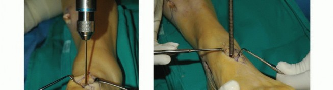 Illustration 31 for Foot Drop Surgery: How a Pin or Drill Elevates Tendon Transfer