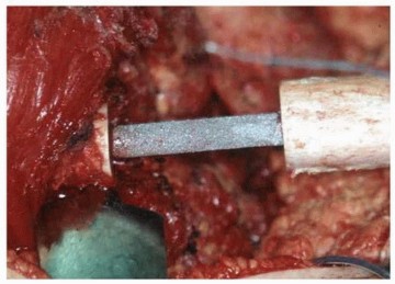 Illustration 13 for Allograft Prosthetic Composite: Mastering Proximal Femur Reconstruction