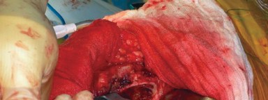 Illustration 6 for Cemented Femoral Stem Figures: Surgical Anatomy & Placement