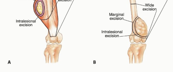 Illustration 28 for Understanding Benign Bone Tumors: Your Complete Preoperative Guide