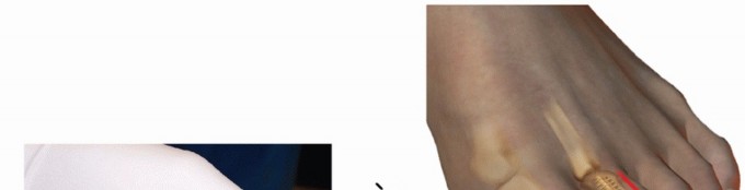 Illustration 35 for Hammer Toe Correction: Understanding the Extensor Digitorum Longus