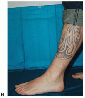 Illustration 50 for Unlock Healing: Medial Malleolar Osteotomy for Talus OLT Allografts