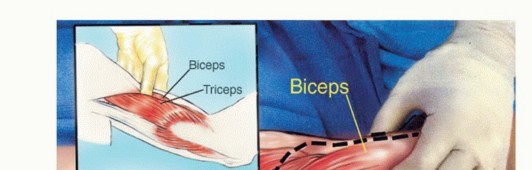 Illustration 6 for Distal Humeral Resection: Safe Techniques for Limb Preservation