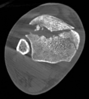 Illustration 7 for Complex Tibial Shaft Fracture: Plate Fixation for Plafond Extension