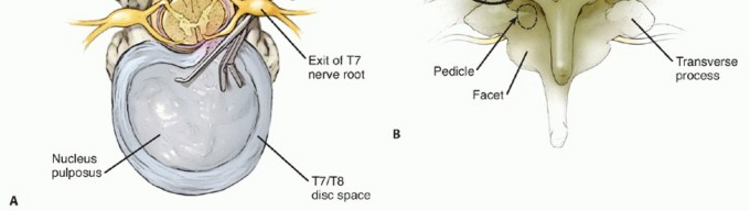 Illustration 4 for Anterior Thoracic Corpectomy: Decompression, Stabilization, Fusion
