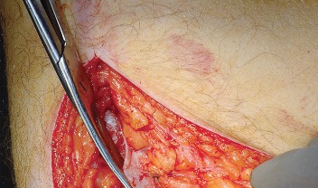 Illustration 10 for Unlock the Figure Posterior Approach to the Hip