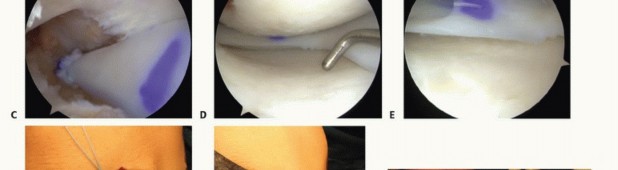 Illustration 28 for Symptomatic Knee? Meniscal Transplant for Anterior & Posterior Horns
