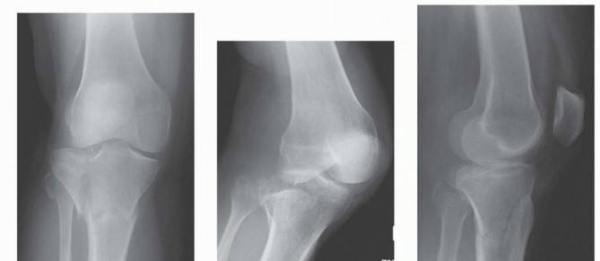 Navigating Bicondylar Tibial Plateau Fractures: A Surgical Guide