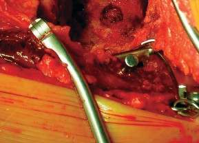 Illustration 51 for Cemented Component Longevity: The Critical Margin of the Acetabulum