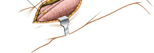 Illustration 60 for Mastering the Approach to the Distal Humerus: Safety & Skills