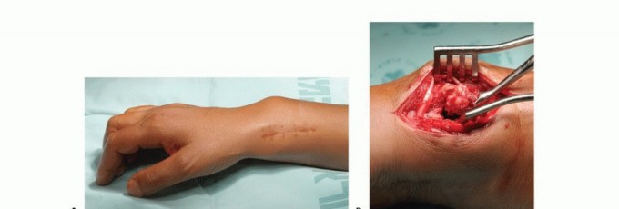 Illustration 17 for Avoid Major Surgery: Bone Tumor Treatment with Liquid Nitrogen Pour