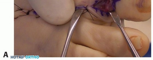 Illustration 38 for Hammer Toe Correction: Understanding the Extensor Digitorum Longus