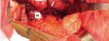 صورة توضيحية لـ إتقان توازن الأنسجة الرخوة لمفصل ورك صناعي مثالي: دليل شامل للمرضى مع الأستاذ الدكتور محمد هطيف