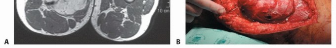 Illustration 12 for Optimizing Adductor Muscle Group Resection for Limb Preservation