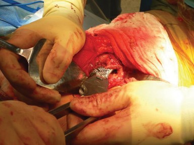 Illustration 11 for Cemented Femoral Stem Figures: Surgical Anatomy & Placement