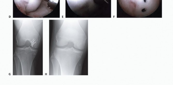 Illustration 31 for Dissecans of the Knee: What's the Difference – OCD vs. AVN?