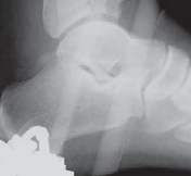 Illustration 21 for Optimizing ORIF for Tibial Plafond Fractures: A Modern Approach