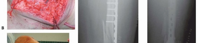 Illustration 63 for Repairing Distal Femur Fractures: Open Reduction & Internal Fixation