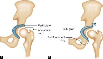 Illustration 27 for Total Hip Replacement for Protrusio: Restore Your Hip Function
