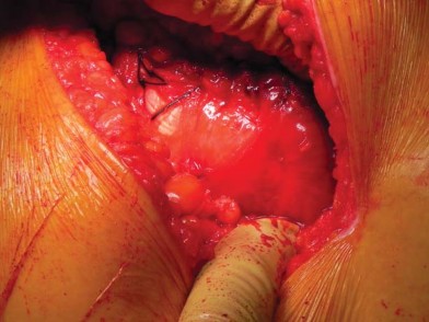 Illustration 61 for Unlock better THA: The technique of short stem for less invasiveness