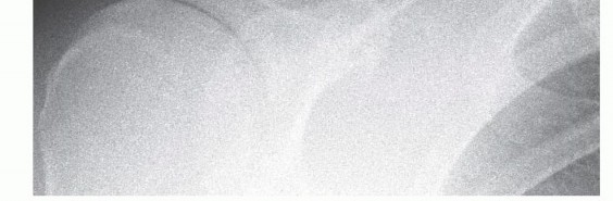 Arthroscopic AC Joint Stabilization: The Dog Bone Button Method