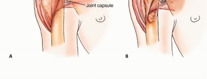 Illustration 3 for Restore Vital Function: Surgery for Type II Humeral Metastasis