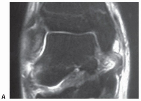 Illustration 17 for Medial Ankle Instability: Find Relief with Reconstruction