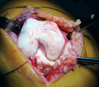 Illustration 8 for Minimally Invasive Subvastus: The Best Path to Quicker TKA Recovery