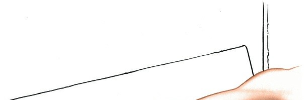 Illustration 2 for Essential Surgical Approaches: Uncover Every Aspect of the Wrist