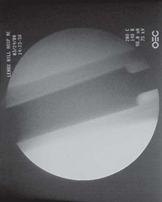 Illustration 27 for THA for patients with proximal femoral deformity: Practical solutions