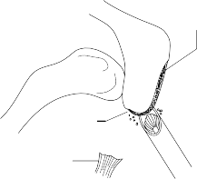 Illustration 11 for Mastering Surgery of the Undersurface of the Acromion