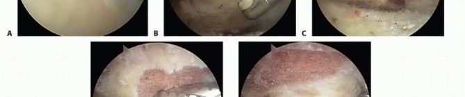 Illustration 8 for Find Relief: Arthroscopic Subacromial Decompression for Impingement