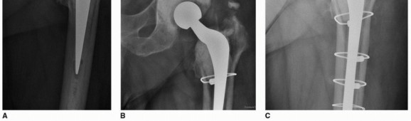 Illustration 55 for Cement in Cement Revision: Simplifying Complex Hip Revisions