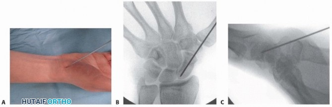 Illustration 9 for Mastering Percutaneous Fixation of Acute Scaphoid Fractures