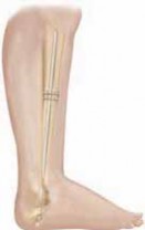 Illustration 16 for Solving Congenital Pseudarthrosis: Tibia with the Williams Rod