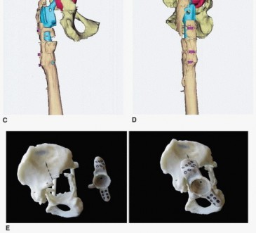Illustration 4 for Custom Triflanged Devices: Solving Massive Acetabular Bone Loss