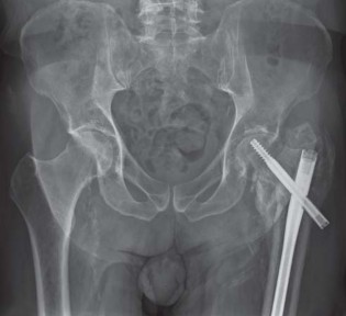 Illustration 32 for Effective Arthroplasty for Salvage of Failed Hip Fixation