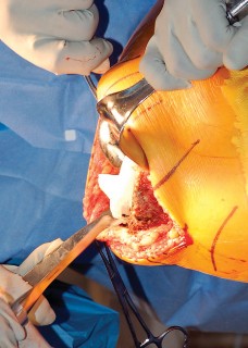 Illustration 16 for Mastering Gap Balancing in Revision TKA: Avoid Common Pitfalls